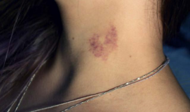 5 Easy Ways to Get Rid of a Hickey Fast